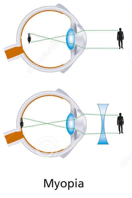 myopia visualised